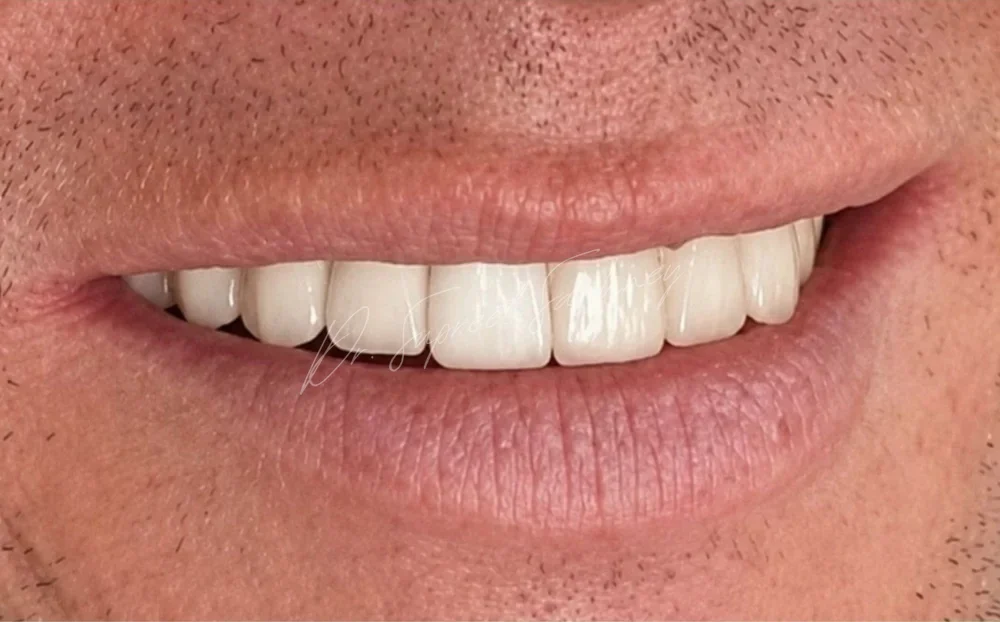 Close-up smile photograph after anterior aesthetic rehabilitation, showing restored maxillary anterior teeth